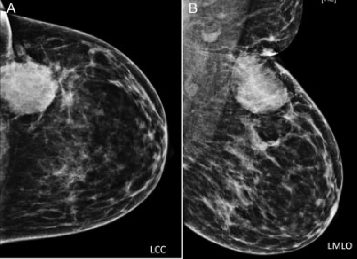 Mammogram Reporting